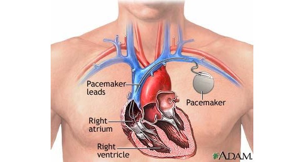 headphones, earphones, earbuds, pacemaker, defibrillator, , , 